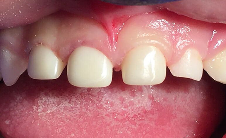 Pediatric Zirconia Crowns After Photo