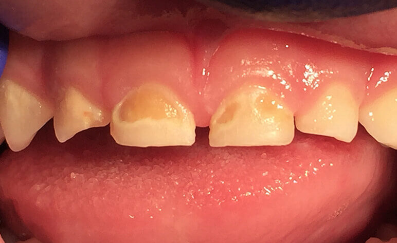 Pediatric Zirconia Crowns Before and After – Zirconia Crown in Pediatric Dentistry