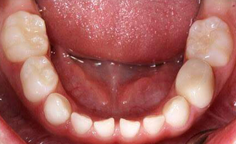 After Aesthetic Crowns for Primary Teeth