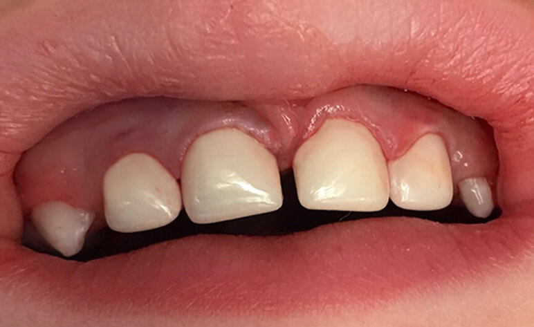 After Aesthetic Crowns for Primary Teeth