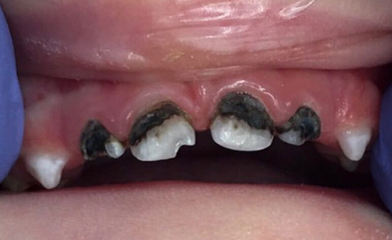 Before Milled Zirconia Crowns for Children