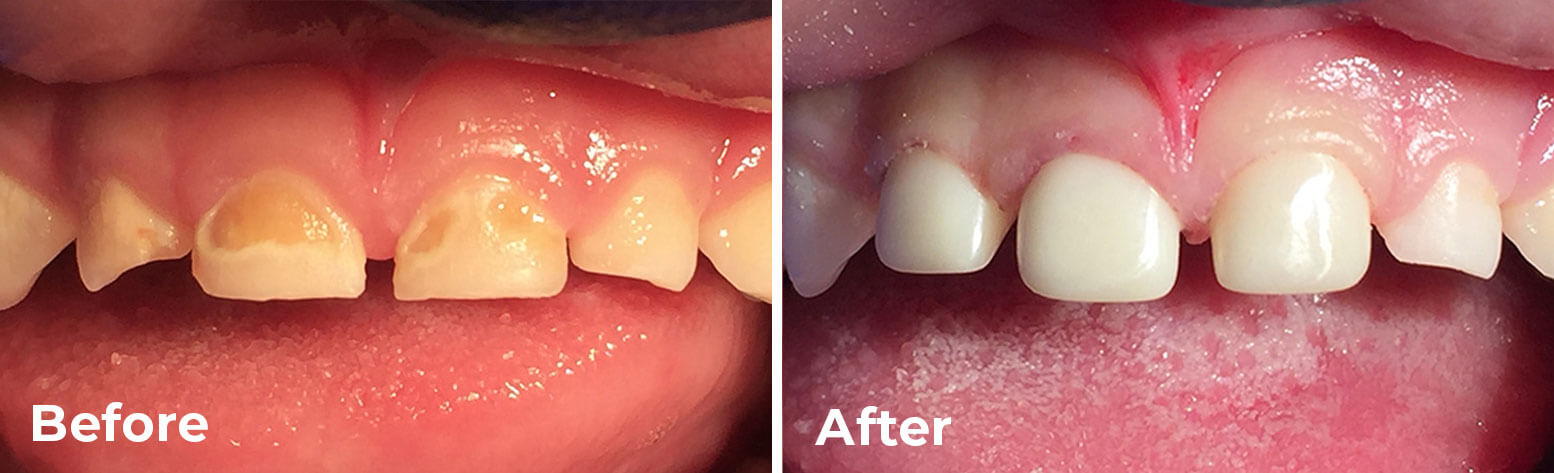 Cavities in baby teeth – before and after pediatric crowns in children’s teeth