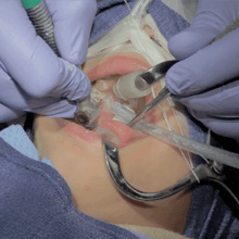 crown preparation procedure video – dental crown prep