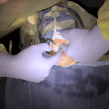 Cheng Crowns pediatric dentistry video - dental surgery video for pediatric crowns