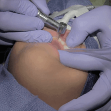 pediatric crown prep video – zirconia crown preparation procedure – how to do a crown prep