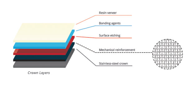 Stainless Steel Pediatric Crowns with Classic Metal-Reinforced Substructure