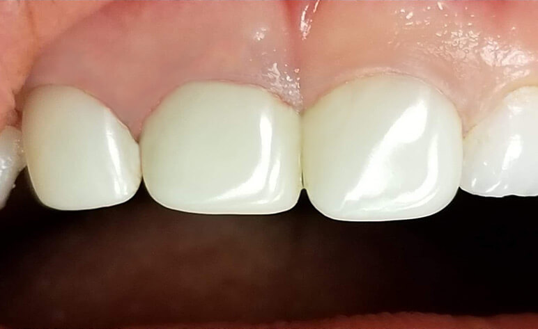 Pediatric Zirconium Crowns After Photos