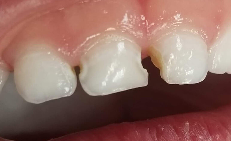 Before Pediatric Zirconia Crowns