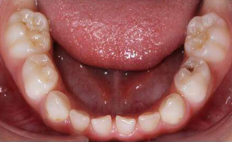 Before Milled Zirconia Crowns for Children