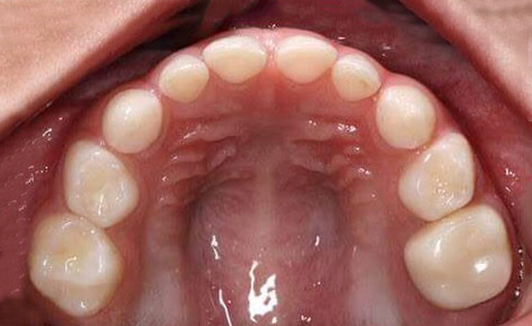 Pediatric Zirconium Crowns After Photos