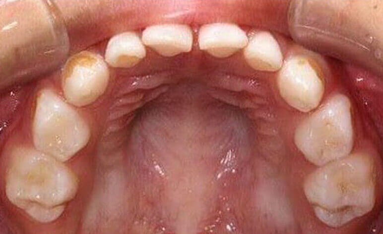 Before Pediatric Zirconia Crowns