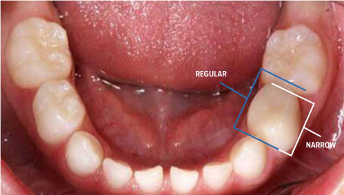 Pediatric Ceramic Zirconia Crowns