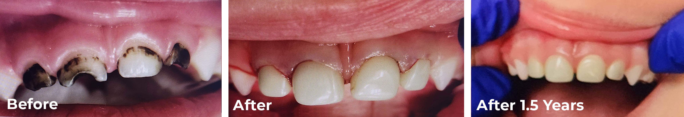 Fillings vs pediatric crowns for baby teeth – before and after zirconia crowns for children